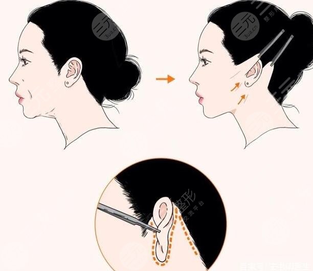 小切口拉皮除皺術(shù)價(jià)格多少？