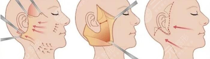 小切口拉皮除皺術(shù)需要注意什么呢?
