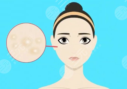 臉部長(zhǎng)有脂肪粒是怎么回事？