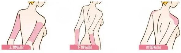 手臂吸脂的恢復期長嗎?