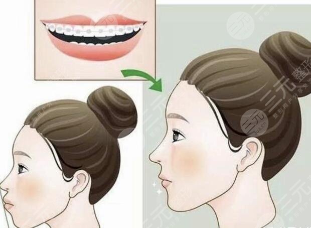 美容冠矯正齙牙的注意事項(xiàng)