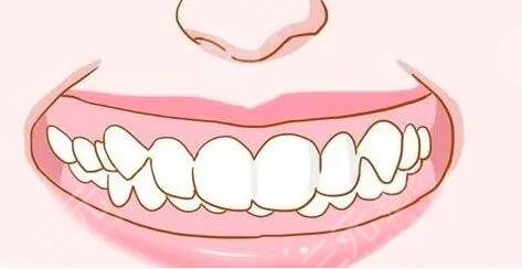 美容冠矯正齙牙果嗎?