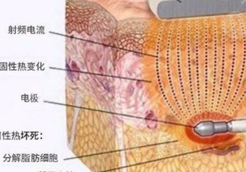 鐳射溶脂的危害有哪些？