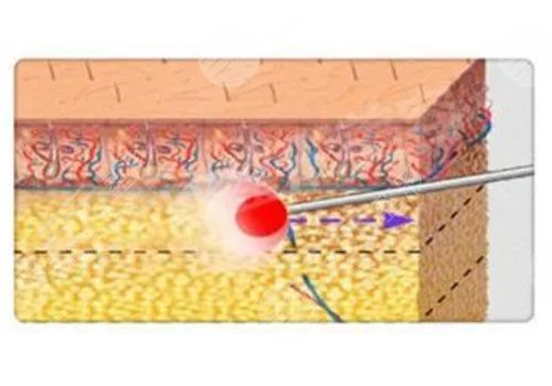 鐳射溶脂的危害有哪些？