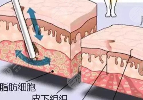 鐳射溶脂的危害有哪些？