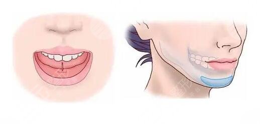 隆下巴整形手術(shù)