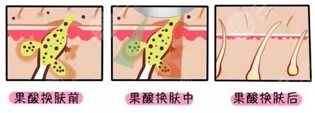 做果酸美膚的注意事項