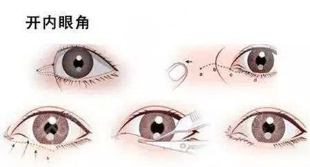 開眼角手術(shù)痛嗎?