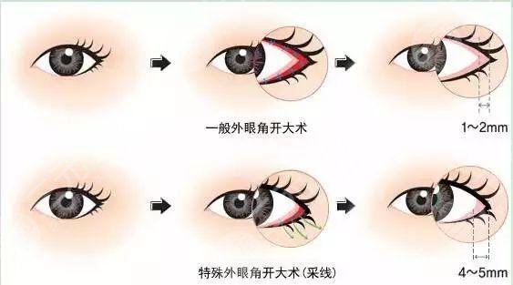 開眼角手術(shù)痛嗎?