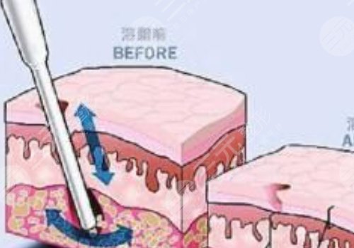 做了鐳射溶脂之后需要注意什么?