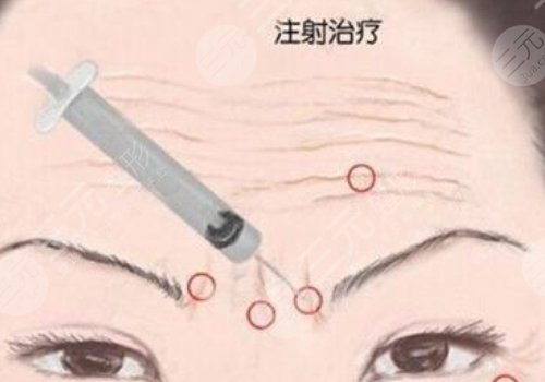 瑞蘭2號玻尿酸多少錢？