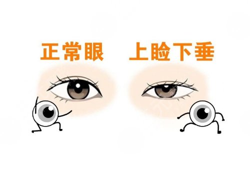 上瞼下垂矯正大概需要多少費(fèi)用?