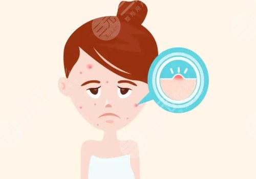 激光祛痘坑痘印有沒(méi)有危害?