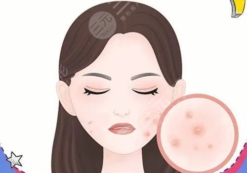 激光祛痘坑痘印有沒(méi)有危害?