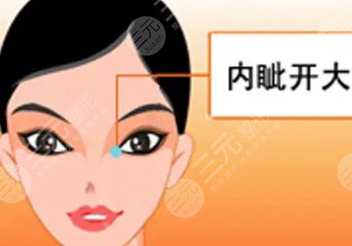 影響開內(nèi)眼角手術價格的因素有哪些?
