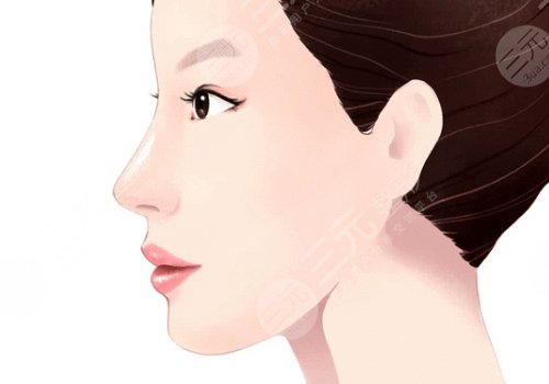 玻尿酸隆鼻會不會鼻梁越來越寬?