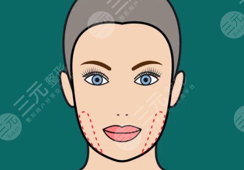 下頜角切除手術(shù)后遺癥有哪些?