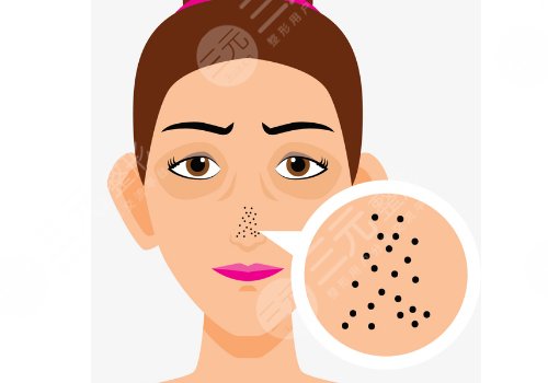 黑頭導出液真的有用嗎?