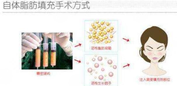 全臉脂肪填充的好處