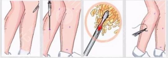 小腿吸脂術(shù)效果好嗎？