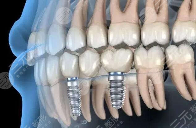 種植牙5年種植體還能拿出來嗎？