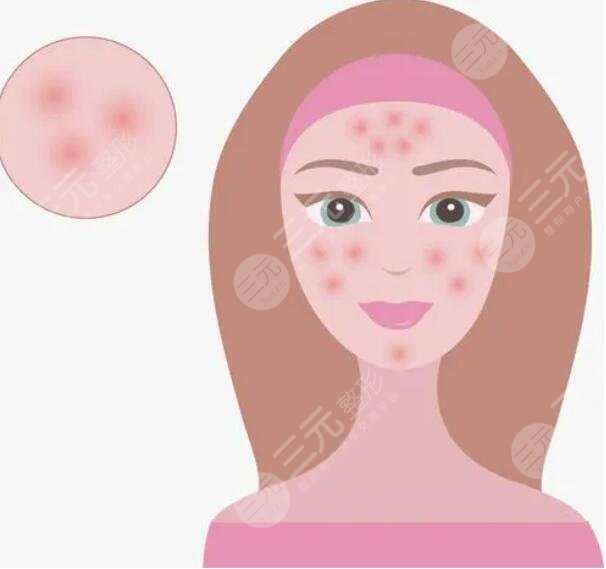 痤瘡的緩解方法有哪些？從生活作息、飲食習(xí)慣、藥物緩解等方面下手！