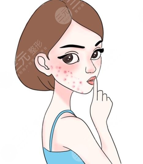 痤瘡的緩解方法有哪些?