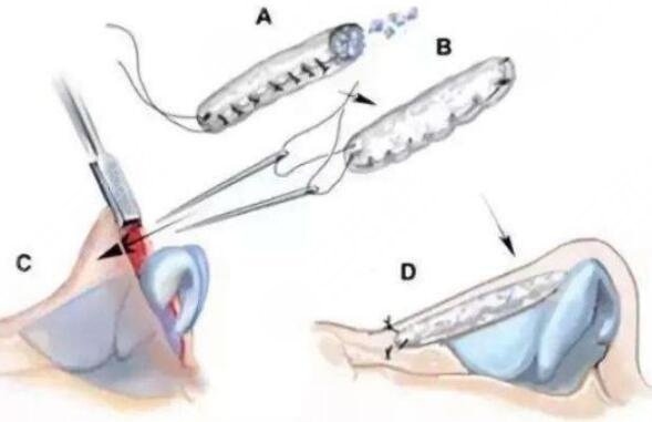 隆鼻需要多長(zhǎng)時(shí)間恢復(fù)?