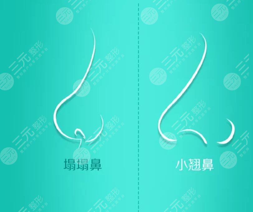 鼻子整形后要注意什么？