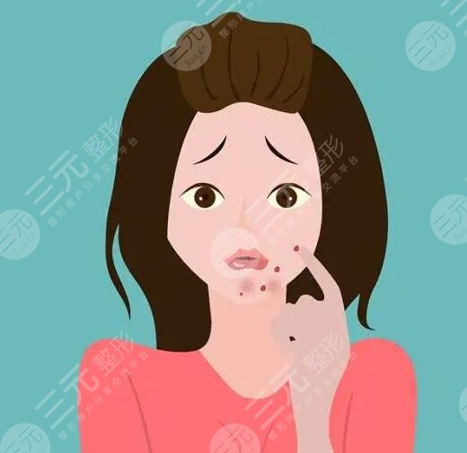 　　如何快速去青春痘?對于青春期的男生和女生們來講，大多數(shù)人都難逃青春痘的困擾，青春痘嚴(yán)重的時候會影響到一個人的顏值，所以青春期的男生和女生們大多都在戰(zhàn)“痘”，可是在緩解痘痘的時候也需要選對方法，不要盲目的去除痘痘，以免對皮膚造成傷害，下面做一個護膚達(dá)人，就來帶大家深入的認(rèn)識一下，如何快速去除青春痘?被青春痘困擾的男生女生可以詳細(xì)來了解一下。  　　1、如何快速去青春痘?  　　日常生活中快速去除青春痘的方式，常見的有藥物緩解、激光緩解以及紅藍(lán)光照射等，可以根據(jù)自己的皮膚狀態(tài)選擇適合自己的去除青春痘方式。  　　(1)藥物緩解  　　皮膚上的青春痘可以在專業(yè)醫(yī)生指導(dǎo)下，使用紅霉素軟膏或者阿達(dá)帕林凝膠進行緩解，這些藥膏能夠快速消除青春痘。但是需要在專業(yè)醫(yī)生指導(dǎo)下規(guī)范用藥，不要盲目的使用，以免對皮膚造成傷害。  　　(2)激光緩解  　　激光緩解青春痘是醫(yī)療美容界的一種新型祛痘方式，激光緩解青春痘的原理，主要通過激光儀器所發(fā)出的高能熱量穿透皮膚表皮層，直接作用在皮膚基底層，這種熱量能夠促進皮膚深層細(xì)胞組織生長，從而可以讓皮膚上的青春痘逐漸修復(fù)，可以讓皮膚恢復(fù)到光滑平整的目的。  　　(3)紅藍(lán)光照射  　　紅藍(lán)光照射緩解青春痘，主要采用專業(yè)儀器發(fā)出的紅光熱效應(yīng)和藍(lán)光熱效應(yīng)對皮膚進行交替照射，緩解皮膚上青春痘的同時還可以消除皮膚上的炎癥，是緩解青春痘的一種不錯的方式。  　　2、青春痘是怎樣形成的?  　　青春痘大多是因為毛囊皮脂腺炎癥性病變導(dǎo)致的，因為身體的內(nèi)分泌失調(diào)，導(dǎo)致雄激素水平偏高，從而誘發(fā)皮脂腺分泌增多，同時毛孔角化排出也不夠順暢，從而就形成了脂肪酸，繼發(fā)細(xì)菌感染的時候就會形成青春痘。另外在日常生活中長時間喝酒，或者總是吃一些高脂肪飲食，或者是日常生活中總是長時間熬夜也會導(dǎo)致青春痘生長。需要注意的是青春痘并不一定是發(fā)生在青春期的，通常現(xiàn)在大多數(shù)人因為生活節(jié)奏加快，成年人長青春痘也不少見，并且比青春期長的青春痘要比較頑固和復(fù)雜。  　　3、怎樣防止青春痘?  　　想要防止青春痘，在日常生活中要養(yǎng)成良好的飲食習(xí)慣和規(guī)律作息，平時飲食盡量少吃吃熱量比較高和脂肪含量比較高的食物，飲食可以以清淡食物為主，可以適當(dāng)?shù)亩喑砸恍┬迈r的蔬菜和水果，多喝一些溫開水，補充身體所需要的維生素和微量元素，防止身體便秘。另外還要適當(dāng)?shù)募訌婓w育運動，讓身體適當(dāng)?shù)亩喑鲆恍┖?。除此之外要養(yǎng)成良好的規(guī)律作息，每天保持充足的睡眠，不要長時間熬夜，避免有太大的精神壓力和過于抑郁的情緒。