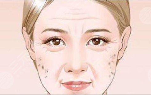 去除老年斑的方法有哪些