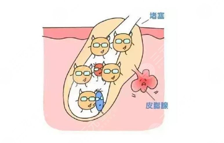 出現(xiàn)痤瘡的主要原因是什么