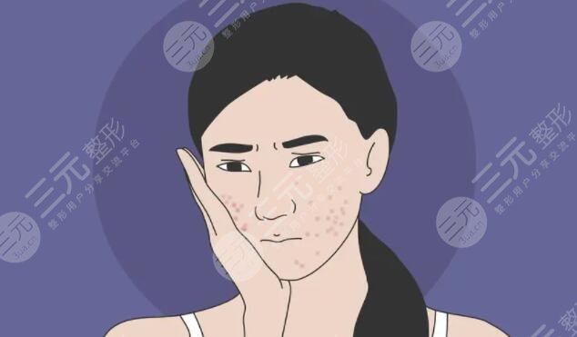 能治好臉上的痘痘嗎？的功效和作用是什么？對皮膚的好處和壞處一覽~