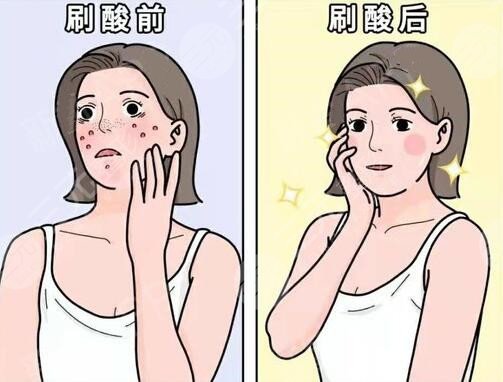 去除痘痘之后多長時間可以恢復(fù)?