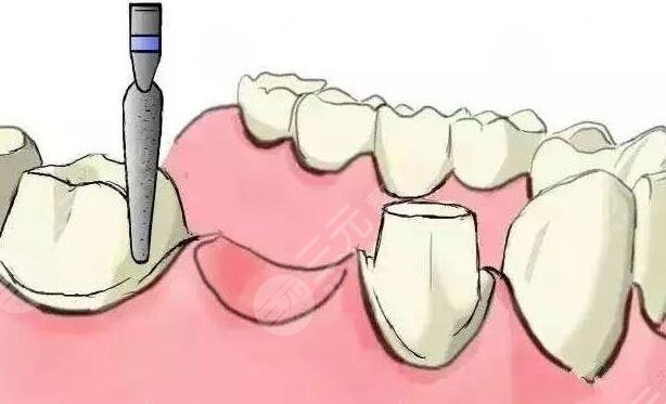 做種植牙的利與弊有哪些?