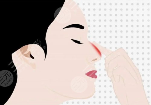 寶尼達(dá)隆鼻會變寬嗎？