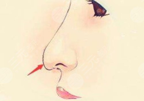 寶尼達(dá)隆鼻可以維持多久？