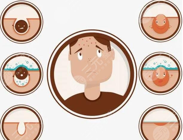 如何快速去除痤瘡見效快?