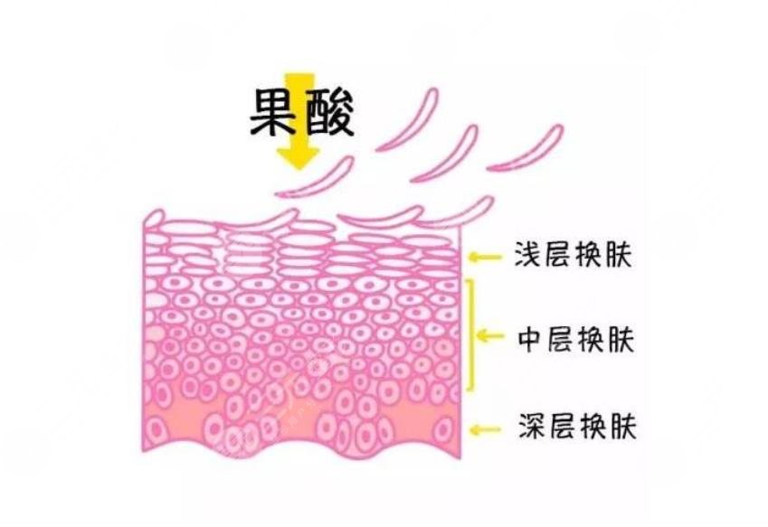 果酸煥膚去痘印有哪些優(yōu)勢?