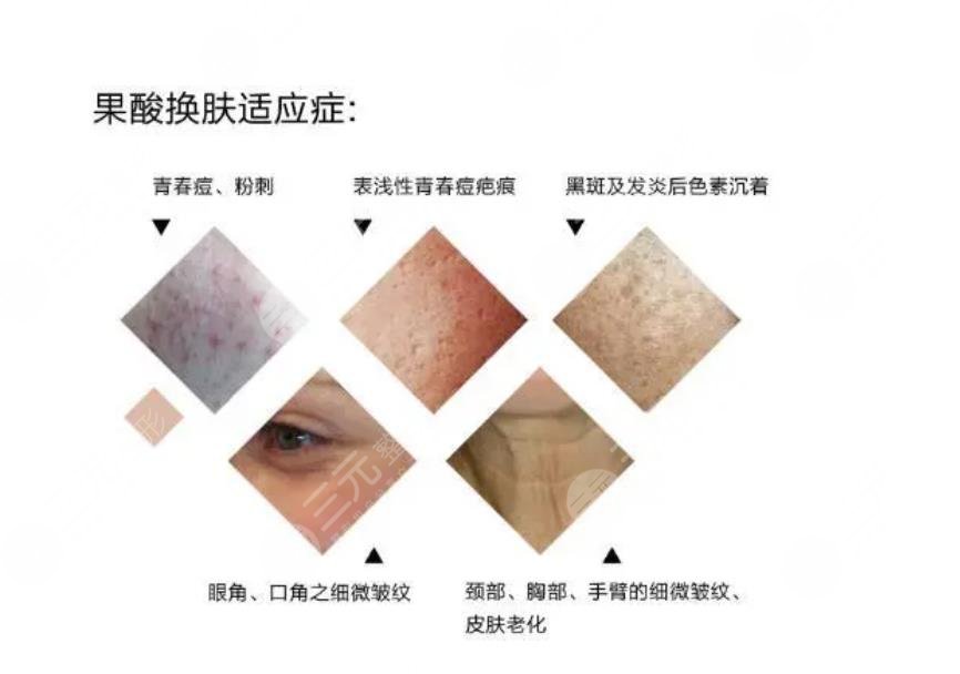 果酸煥膚怎么護(hù)理