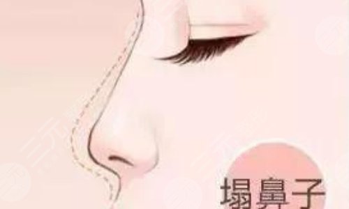 奧美定隆鼻有什么副作用？