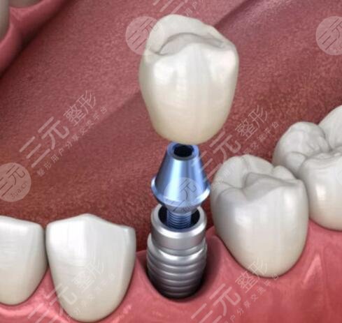 種植牙的利與弊都有哪些？做種植牙的優(yōu)勢(shì)與劣勢(shì)深入分析，使用壽命幾年？