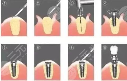 種植牙的使用壽命有多長(zhǎng)？