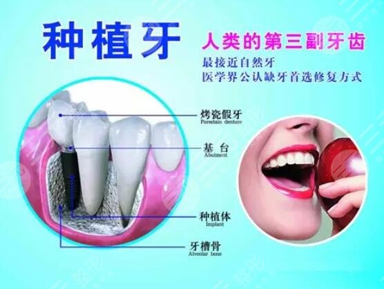 做完種植牙手術(shù)之后需要注意什么?