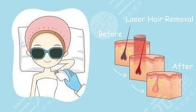 冰點(diǎn)脫毛的具體價(jià)?格曝光