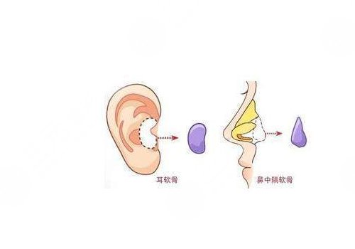 重慶華美做鼻子怎么樣?