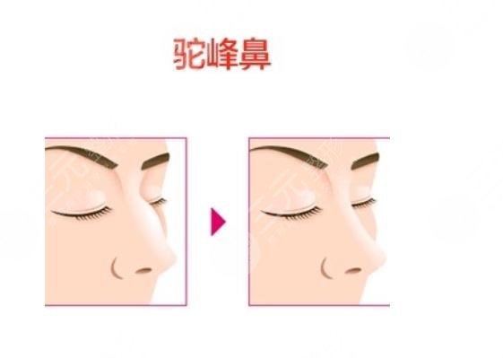 駝峰鼻手術一般多少錢?