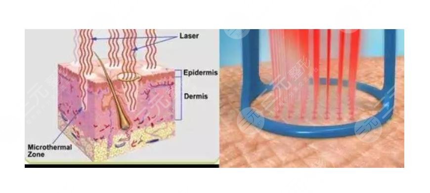 眼周圍有脂肪粒怎么引起的？