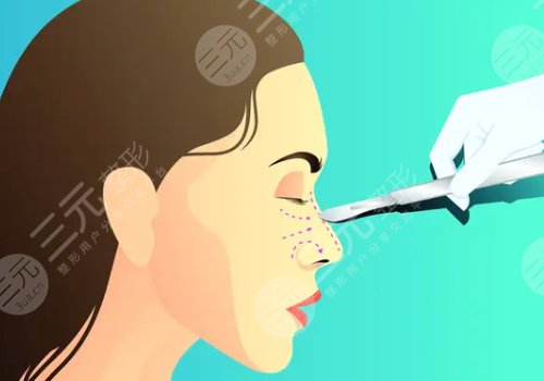 隆鼻有什么危害和后遺癥嗎？