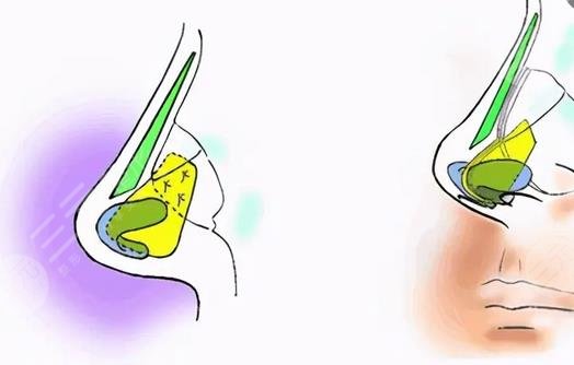 隆鼻有什么危害和后遺癥嗎？